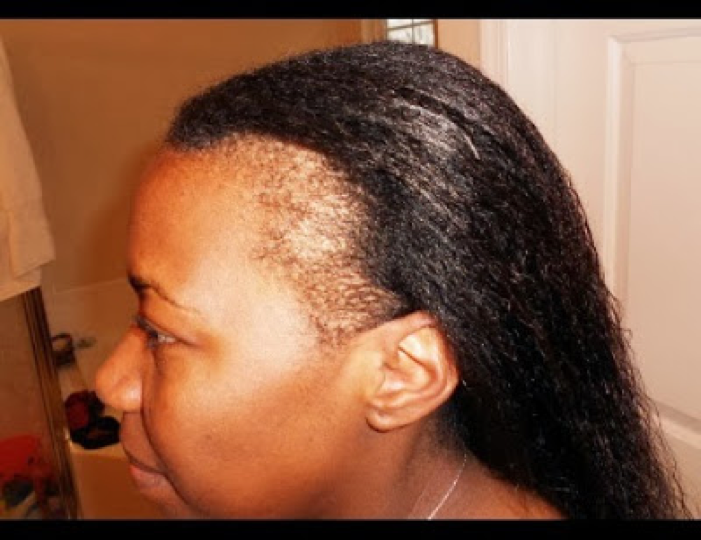 5 Ways to Prevent And Grow Out Thinning Hair Edges